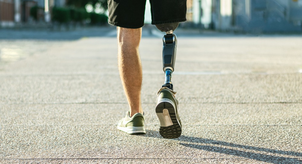 A man in shorts and athletic shoes with no socks visible from the ground to the thighs and pictured from behind, walking on pavement on a sunny day. The man's right leg is a prosthetic limb. Rockpoint Legal Funding is a leading provider of medical liens for the treatment of plaintiffs injured in accidents.
