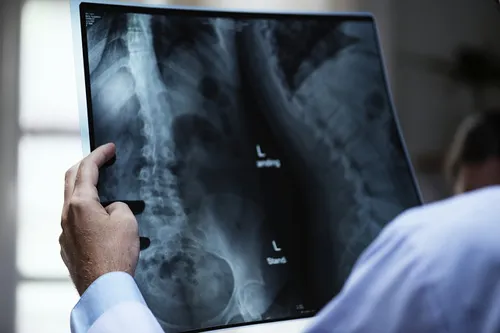 Spine injury surgeries – Time is of the essence