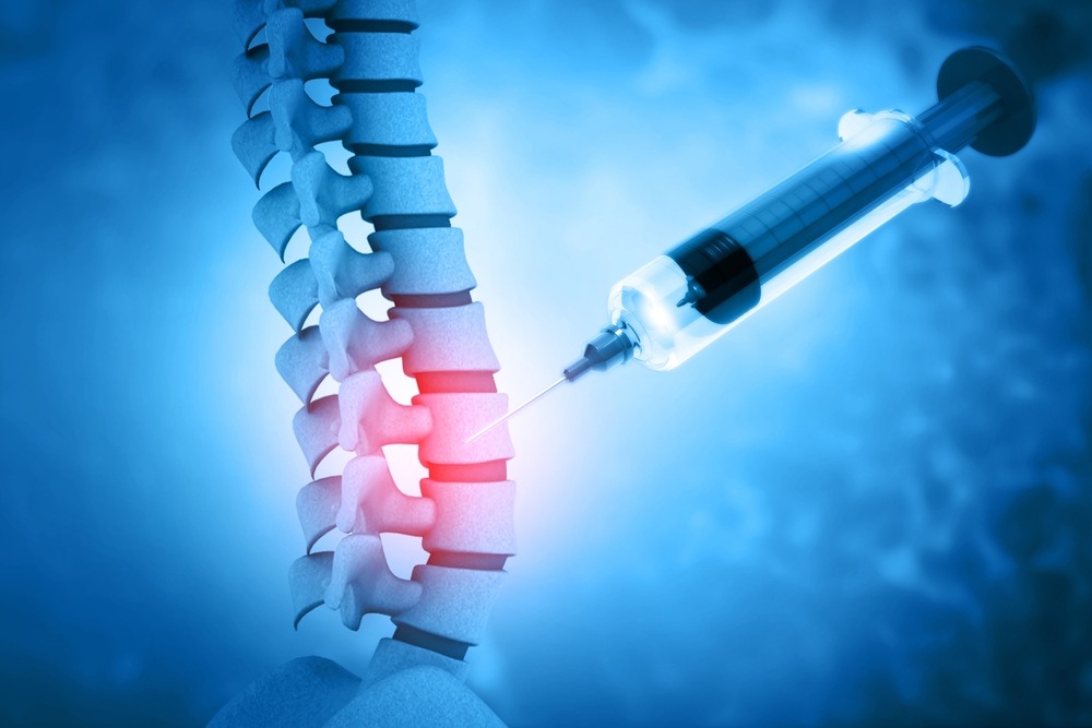 A computer generated image of a spine with a needle and syringe. Rockpoint Legal Funding provides medical lien services for procedures like Medial Branch Nerve Block and Facet Joint Injection.