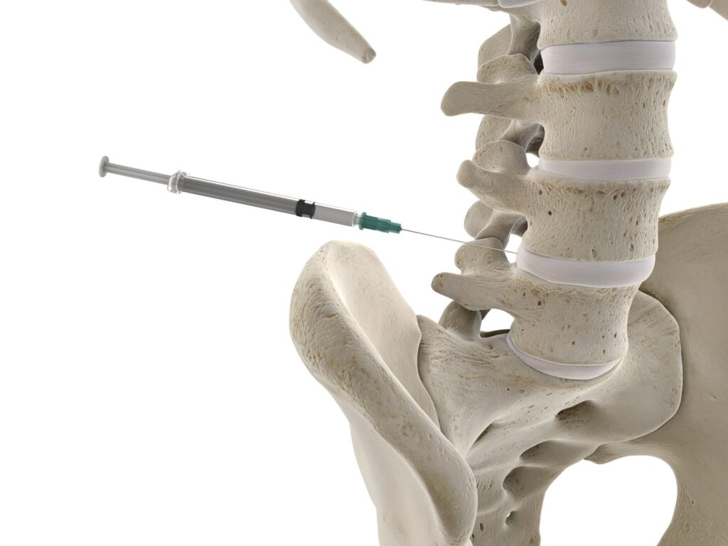 Image of a human skeleton visible from the pelvis to the lowest rib. There is a hypodermic needle going into the space between two of the spinal vertebrae. Rockpoint Legal Funding provides medical lien services for procedures like Lumbar Facet Injections.